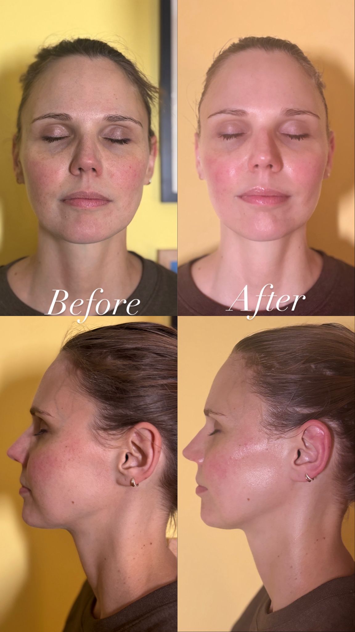 Mukha client before and after myofascial buccal massage Surbiton Surrey