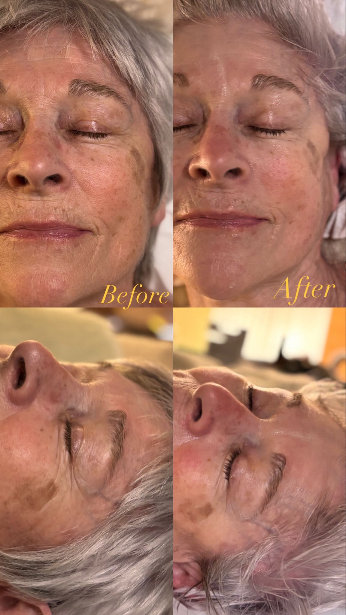 Mukha client before and after facial therapy treatment Surbiton Surrey